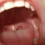 Grzybica jamy ustnej - kandydoza