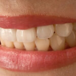erozja szkliwa zębów